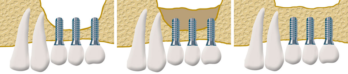 Ein Sinuslift schafft das Knochenangebot um Implantaten einen sicheren Halt zu geben