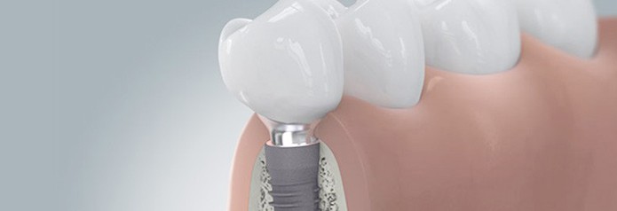 implantation_setzten7